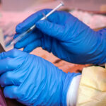Ebola: new outbreak in the Democratic Republic of the Congo, 246 suspected cases and 65 deaths